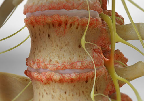 Cervical-Spondylosis