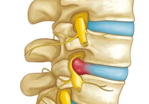 Inter-Vertebral-Disc-Prolapse