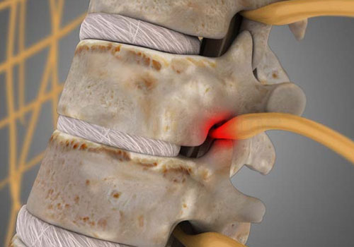 Lumbar-Spondylosis
