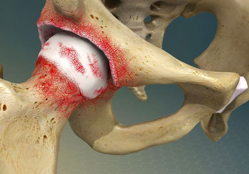 Osteoarthritis