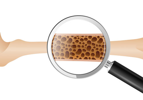 Osteoporosis