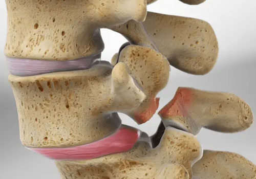 Spondylolisthesis